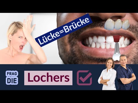 Zahnbrücke vs. Implantat, was ist besser?