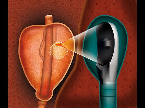 High Intensity Focused Ultrasound at CAMC