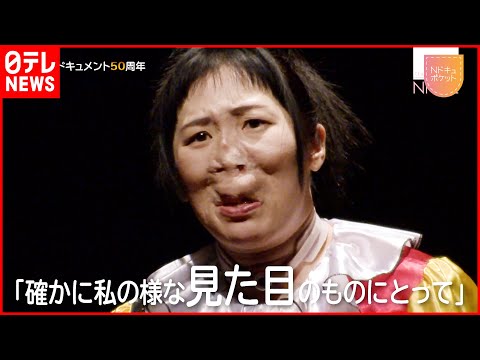 稀な病気を持つ俳優は、外見や反応にどう対処しているかを説明する。「私たちは友達になれるの?」