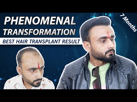 Phenomenal Quick Hair Transformation Result In Just 7 Month || Best Hair Transplant Clinic In India