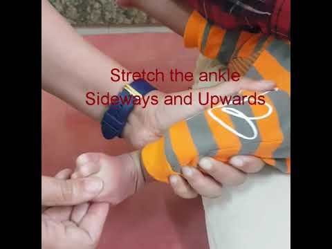 Exercises during brace free time for treated Clubfeet