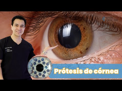 Prótesis de córnea