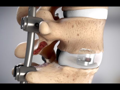 Unleash MIS TLIF System from DePuy Synthes - Ghost Medical, Orthopedic Animation