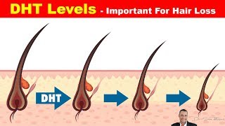 👱 High DHT Affects How Much Hair You Have On Your Head - Hair Loss Part 3