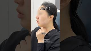 턱살 있었는데? 없어졌습니다💯
