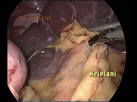 Laparoscopic Splenectomy, Minimally Invasive Spleen Removal