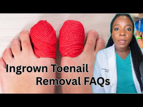 Top 9 FAQs About Ingrown Toenail Removal Surgery | Dr. Tarr