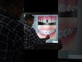 दाँतो के बीच के गैप को कैसे ठीक करें Toothca