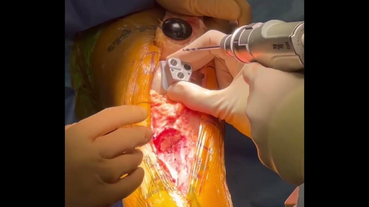 Dr. Garcia demonstrates a custom patellofemoral replacement