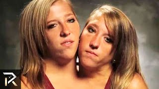 The Most Amazing Conjoined Twins