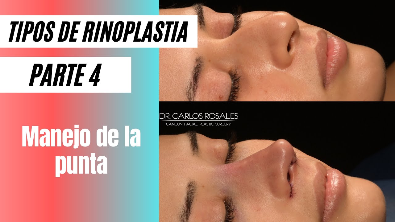 Watch Tipos de Rinoplastia Parte 4 - Manejo de la Punta Now Tipos de Rinoplastia Parte 4 - Manejo de la Punta