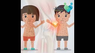 فرفريةهينوخ شونلاين (lgA vasculitis ) Henoch-Schönlein purpura (HSP)