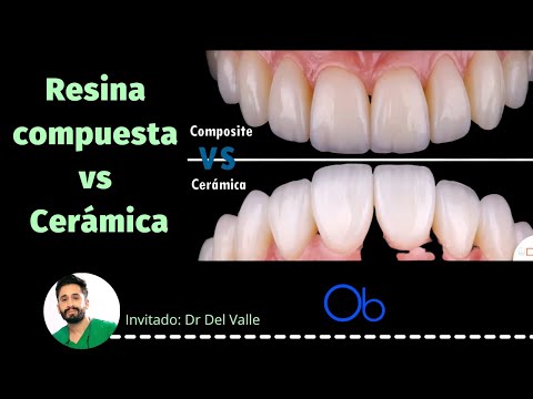 Composite vs Cerámica 🦷