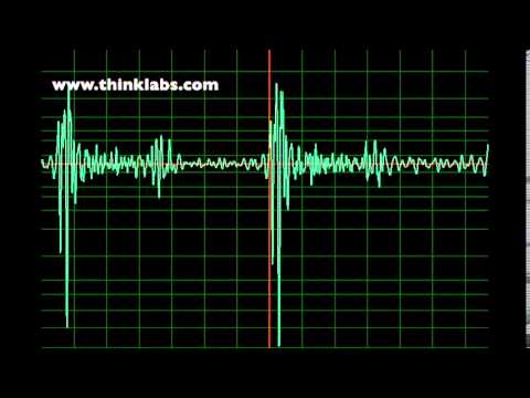 Bicuspid Aortic Valve and Systolic Click- normal speed