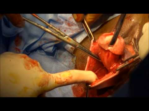 Vaginal Hysterectomy for prolapse uterus