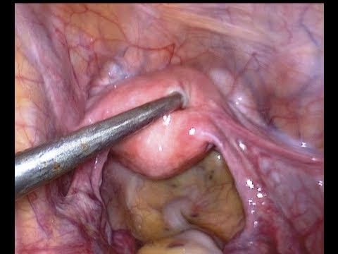 Total Laparoscopic hysetrectomy HD Video