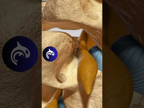 Foraminal Stenosis of the Spine - #4k #3d #animation #backpain #chronicpain #spine