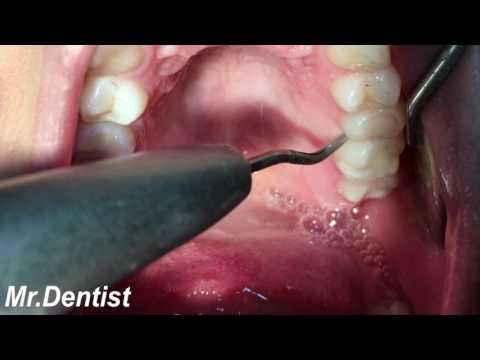 Treatment of periodontal disease !!!