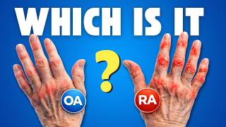 How to Tell if Your Hands Have Osteoarthritis or RA (Fastest Way)