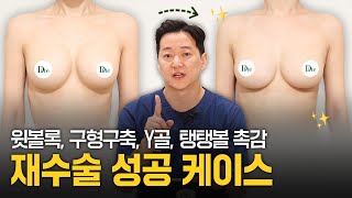 가슴확대 수술 후 생긴 부작용, 재수술로 성공하려면? (feat. 윗볼록, 구형구축, 가슴성형 촉감)
