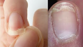 Top 3 Home Remedies To Get Rid Of Weak, Brittle, Cracked And Split Nails