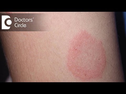 How to manage Chronic Ringworm infection? - Dr. Rajdeep Mysore