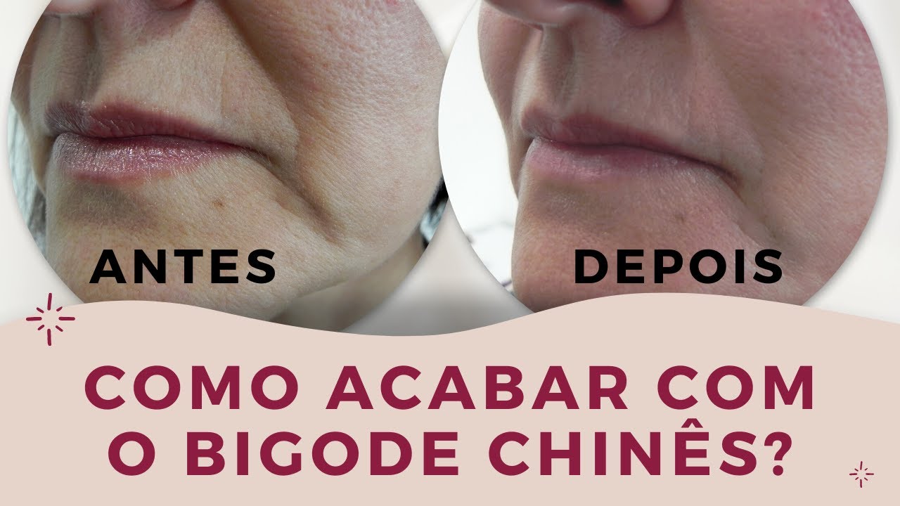 Watch Now Como ACABAR Com o Bigode Chinês Conheça os Adesivos Antissinais Supérbia Como ACABAR Com o Bigode Chinês Conheça os Adesivos Antissinais Supérbia