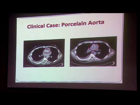 20190831_48_Echocardiography for radiation heart disease_Dr Suma H Konety