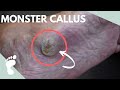 Monster Callus Removal