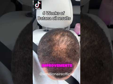 🤔 WHY IS EVERYONE TALKING ABOUT THIS OIL FOR HAIR GROWTH? #alopecia #CCCA #batanaoil