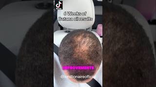 Download lagu 🤔 WHY IS EVERYONE TALKING ABOUT THIS OIL FOR HAIR GROWTH? #alopecia #CCCA #batanaoil mp3