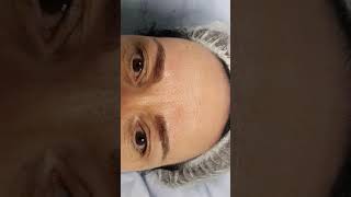 Chemo Eyebrow Loss Restoration Microblading by El Truchan @ Perfect Definition
