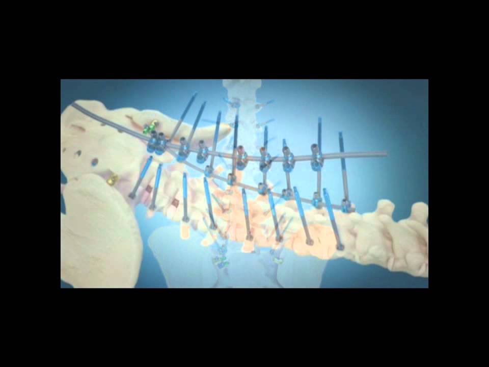 Scoliosis: Surgical Correction with Instrumentation