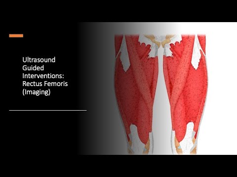 #ultrasound Guided Interventions: Rectus Femoris (Imaging)