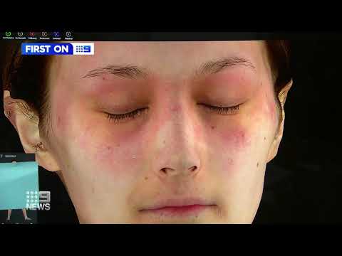 Breakthrough treatment for eczema sufferers.