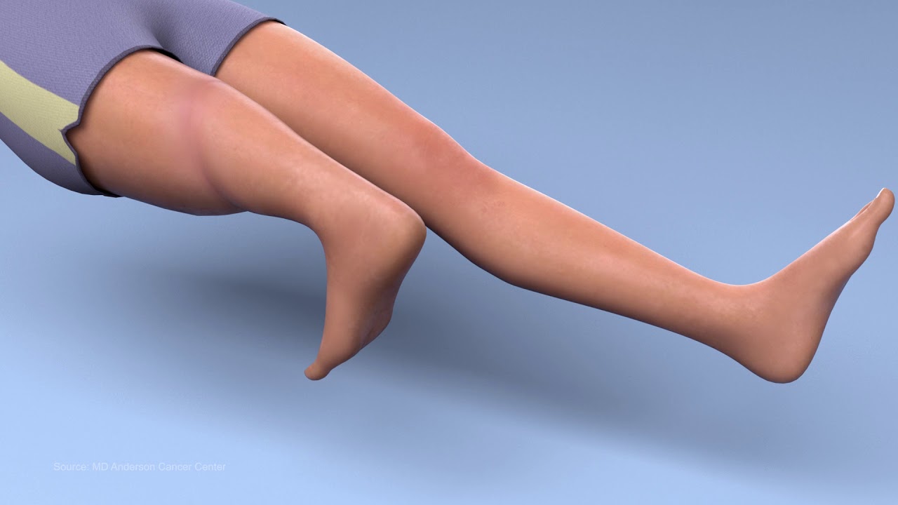 What is a rotationplasty? What is a rotationplasty?