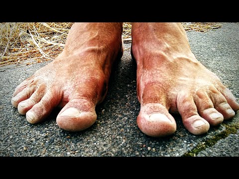 Correct the arched foot? What the orthopedist doesn't know.