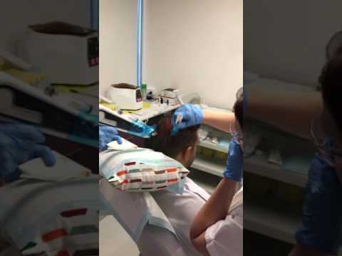  Hair restoration treatment @ Revive my Hair clinics