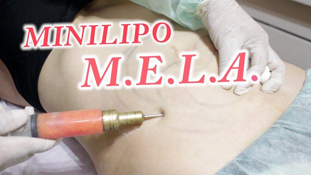 Mini Lipoescultura MELA (
Mini extracción lipídica ambulatoria) tratamiento en adiposidad localizada