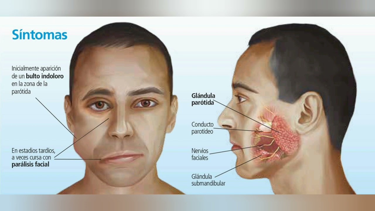 SIALOADENITIS INFECCIÓN DE LAS GLANDULAS SALIVALES BULTO EN REGION MAXILAR
