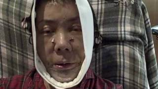 Nancy Ng Recovery Face lift diary