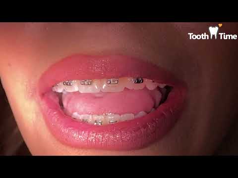 Braces Checkups - Changing Wires NiTi 18x25 to Stainless Steel 19x25 - Power Chains - Tooth Time