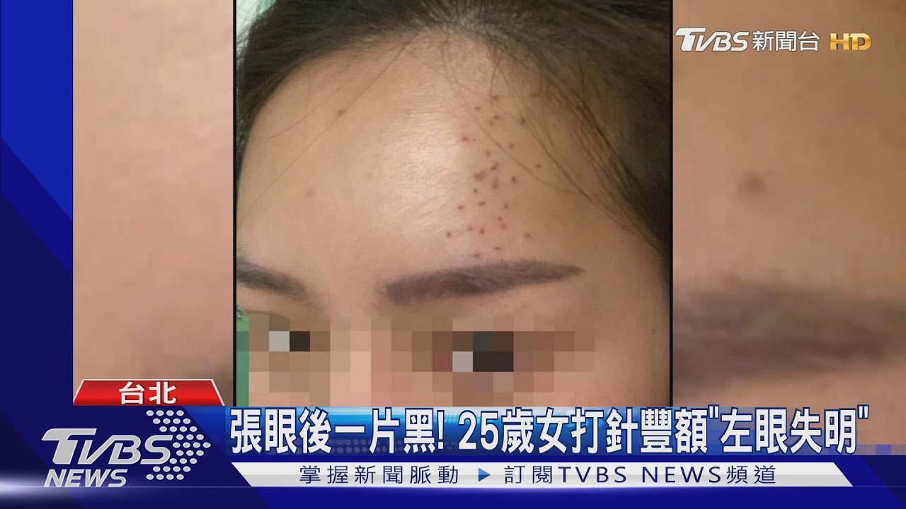 張眼後一片黑! 25歲女打針豐額「左眼失明」