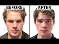Plastic Surgeon Reacts To Clavicular S NEW FACE Nose Job
