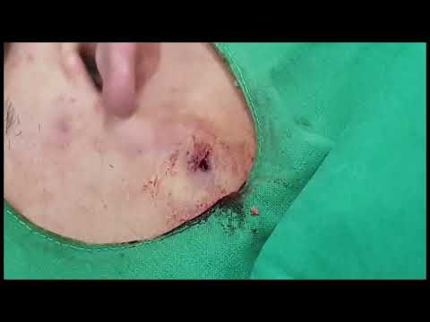 Great big infected cyst! | Mumsnet