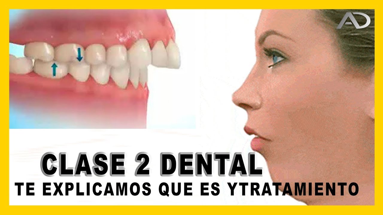 👉Maloclusion dental - 𝙈𝙤𝙧𝙙𝙞𝙙𝙖 𝘾𝙡𝙖𝙨𝙚 𝙄𝙄 dental en Ortodoncia - que es y como corregirla