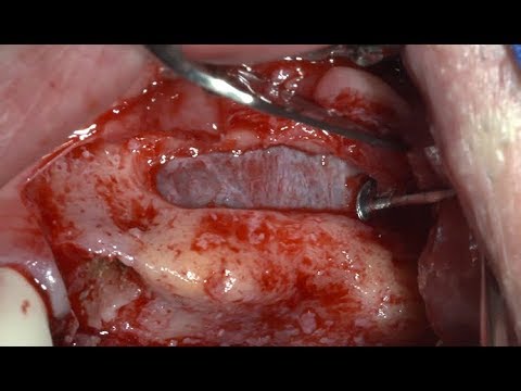 Lateral Approach Through Wide Window - Implantology