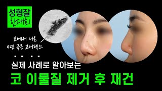 EDITION TV - 아직도 콧대에 고어텍스 있는 분이 있다고!? 코 이물질 제거 후 코재수술