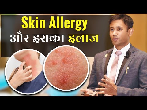 Skin Allergy Treatment at Home | Itching | Khujli Ka Gharelu Ilaj | Dr. Biswaroop Roy Chowdhury