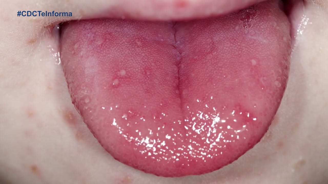 ¿Qué es la enfermedad de manos, pies y boca